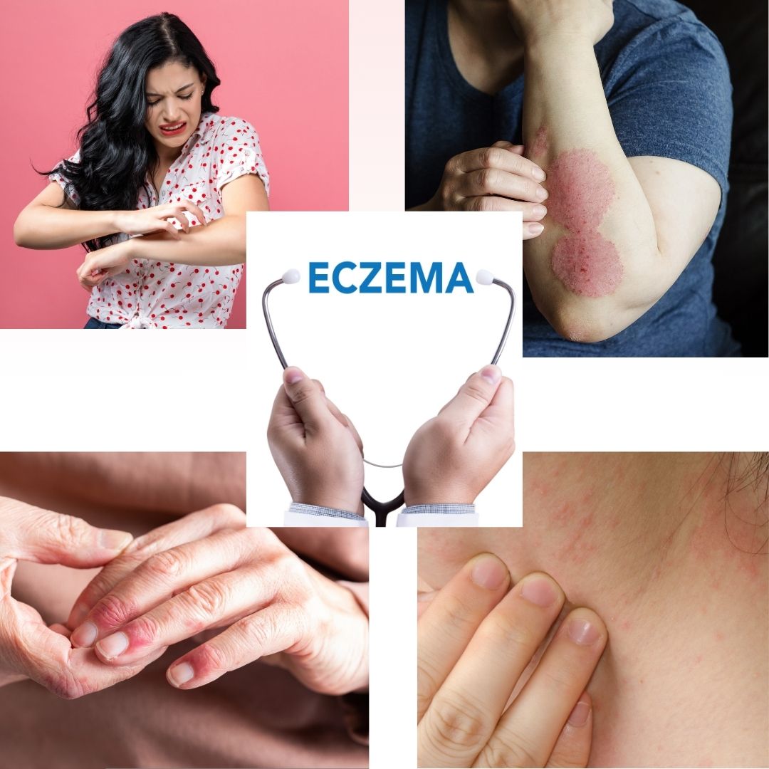 Explore the Benefits of Sesame Oil for Eczema and Dry Skin Relief